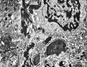 M,1y. | plexus papilloma M,1y. | plexus papilloma